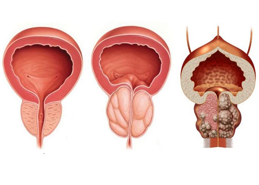 prostatīta posmi un nepieciešamība pilnībā izmantot prostavitu