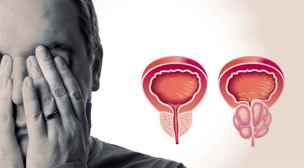 Veselīga un sāpīga prostata vīriešiem